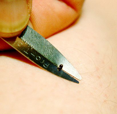 Actual deer tick nymph being removed with Pro-tick Remedy